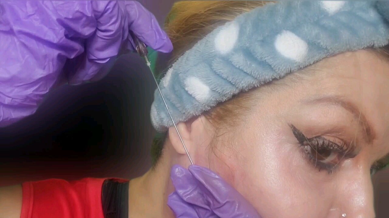 DIY Cog Threads for Jowls & Jawline. Code MANDA- 15% off