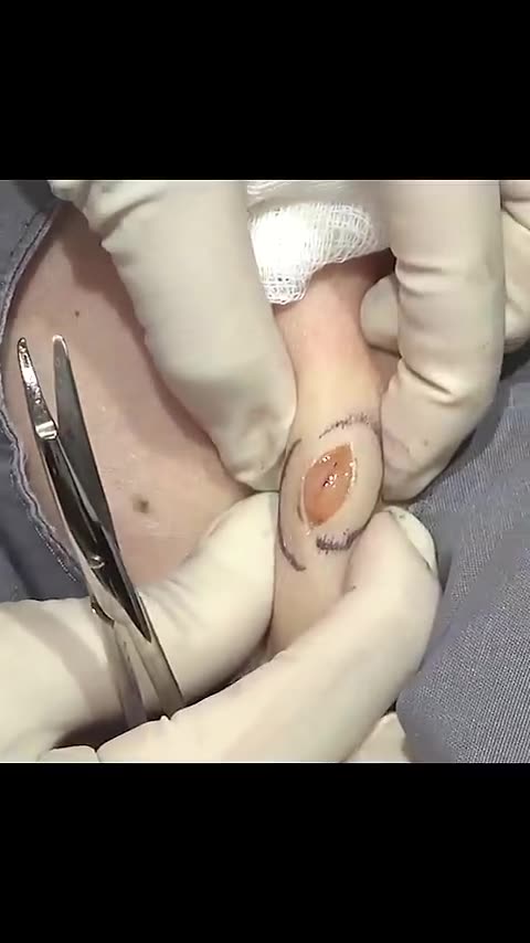 Did you know that you can watch Anna Marie s full procedure of our extraction of 10 lipomas from her