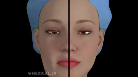 Mini Facelift Surgery (3D Animation)