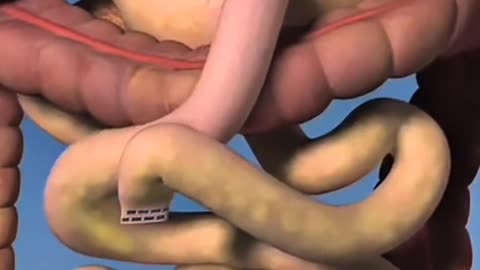 Gastric Bypass Surgery Is Done