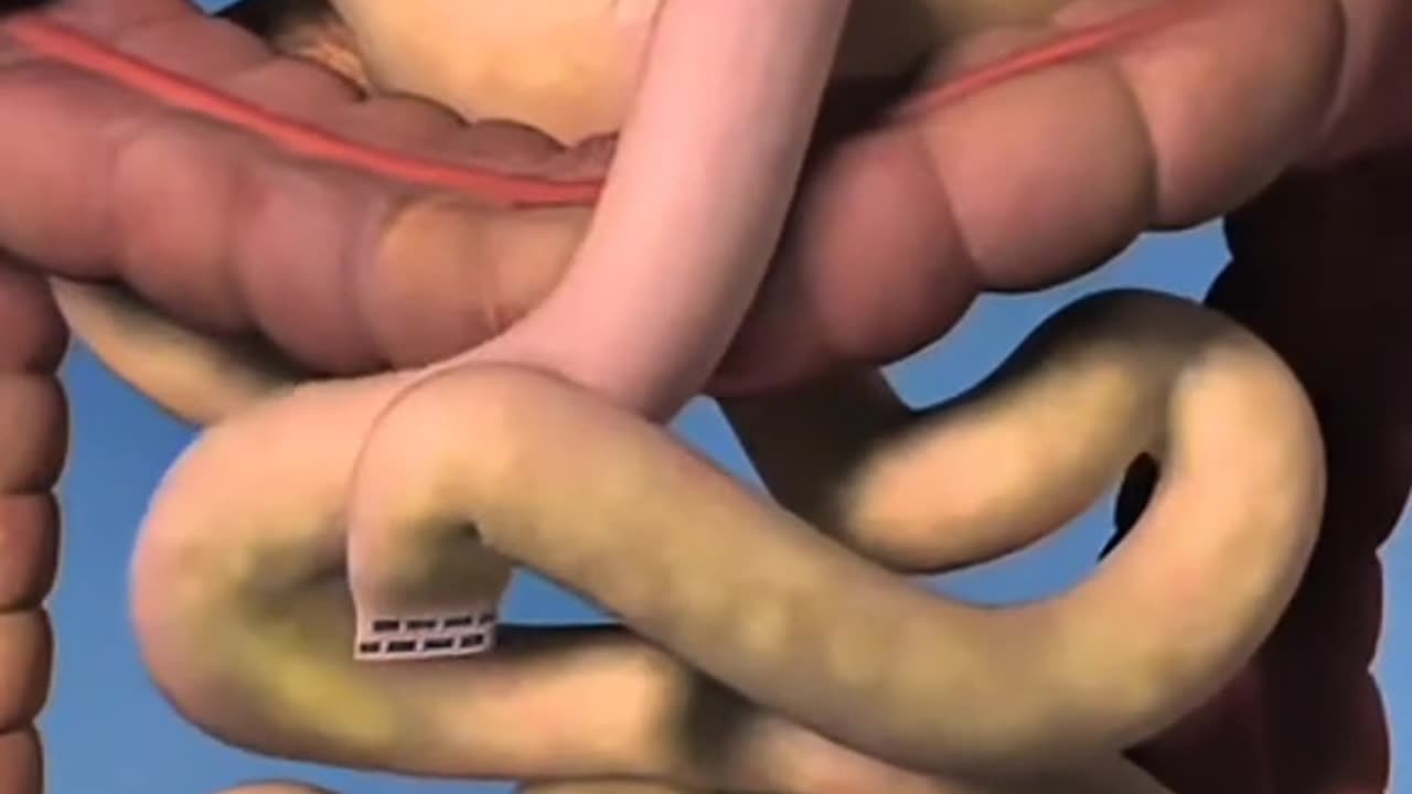 Gastric Bypass Surgery Is Done