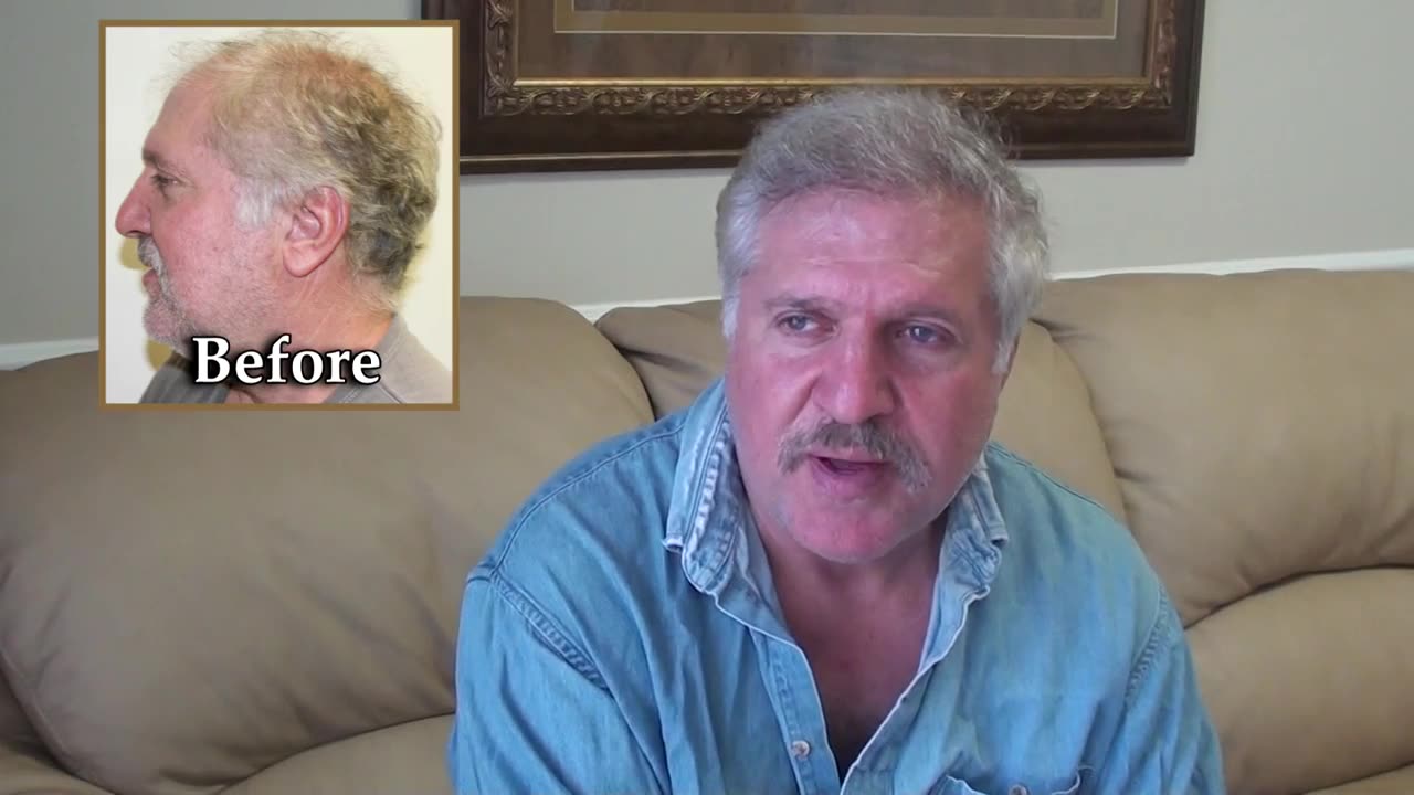 Remarkable Hair Regrowth with Dr. Bolton’s MaxHarvest™ Technique