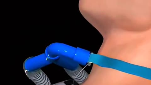 Breathing Through the Neck Here’s Why Some Lives Depend on a Tracheostomy!