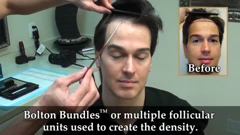 Dr. Brett Bolton Shows Incredible Hair Transplant Scar Result
