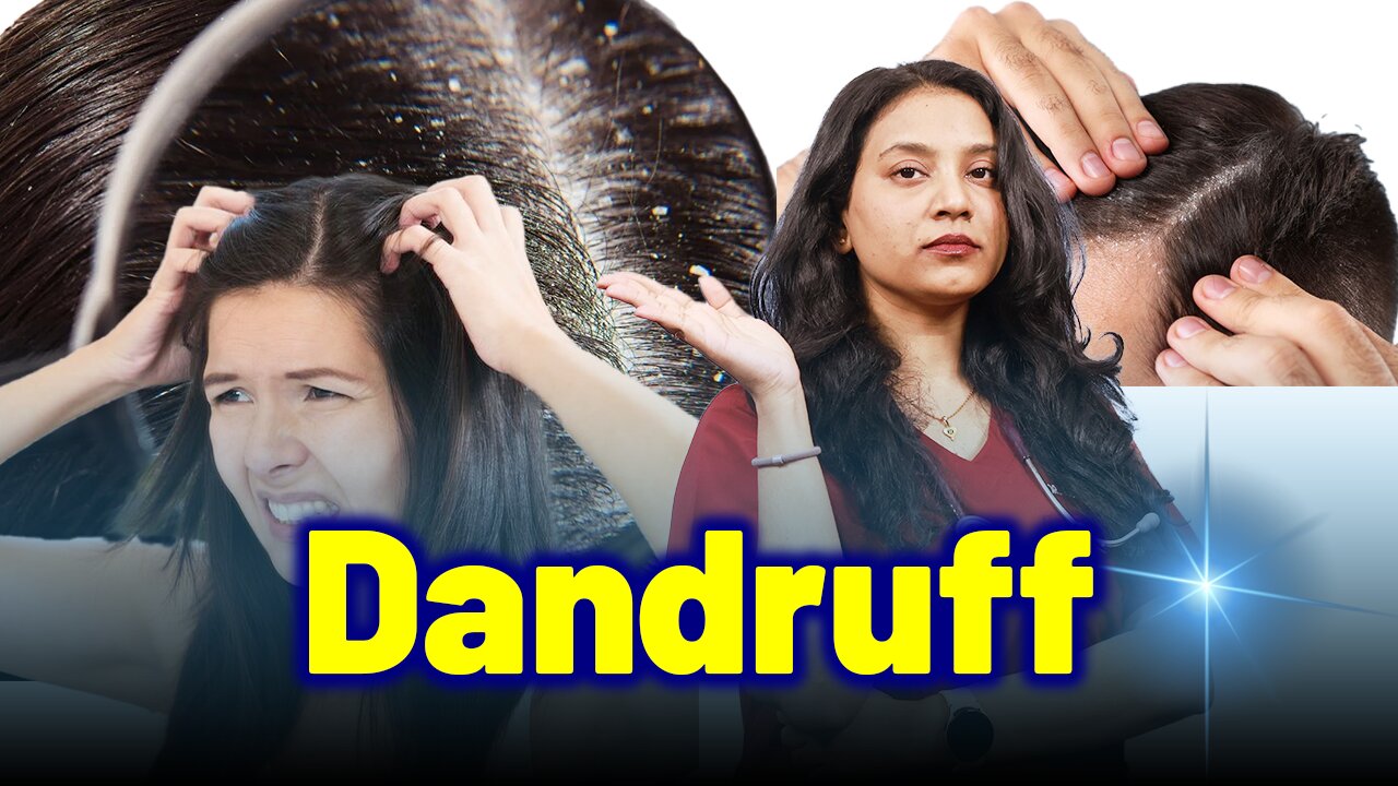 Permanent Solution for Dandruff . | Treatment Cure Relief Medicine | Skin Hair Nail |