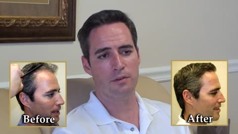 Dr. Brett Bolton | Great Hair Transplant Results