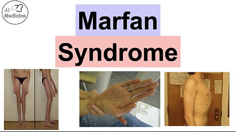 Marfan Syndrome | Genetics, Pathophysiology, Symptoms & Complications, Diagnosis, Treatment
