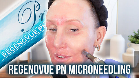 Microneedling with Regenovue PN - Acecosm.com discount code STACY10
