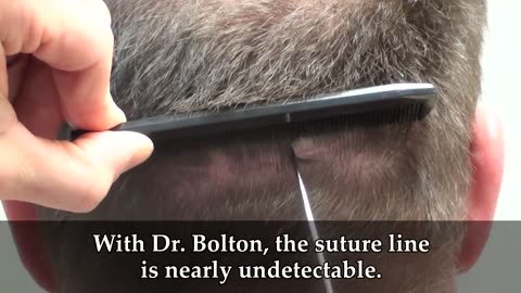 Dr. Brett Bolton Shows Undetectable Hair Transplantation Scar