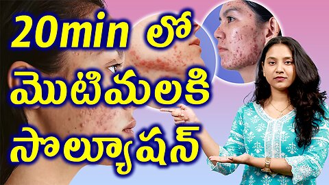 20 min లో మొటిమలకి సొల్యూషన్ Best Solution for ACNE in 2 Mins | డా. భరద్వాజ్ | హోమియోపతి
