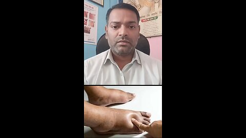 सूजन को कम करने का इलाज ।