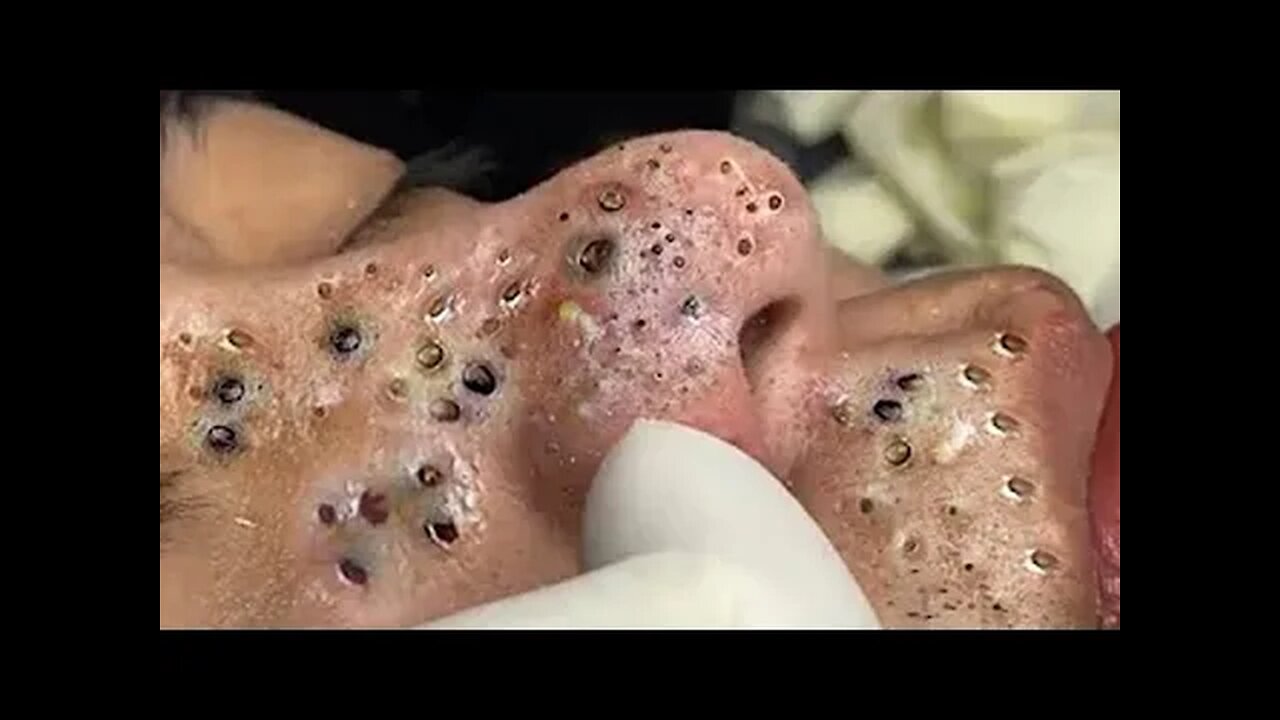 Blackheads Extraction & Milia, Whiteheads Removal Pimple Poppings