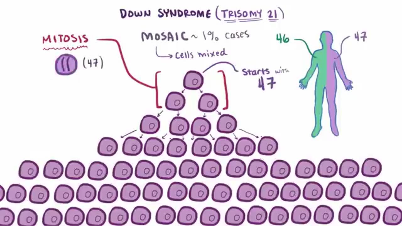 Down syndrome (trisomy 21) - causes, symptoms, diagnosis, & pathology