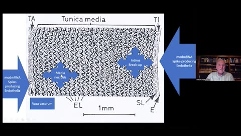 Aortic Dissection Caused By Covid Vaccine: Pathologist Arne Burkhardt (03)