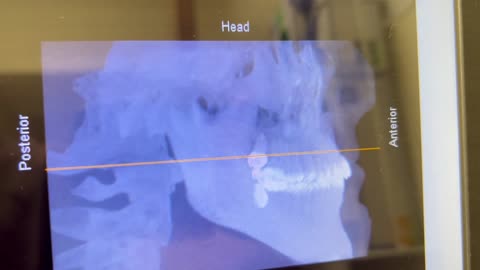 🤯✨ Revealing My Wisdom Tooth X-Ray Before Surgery! | FeedMyCuriosity