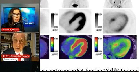 100% OF VAXXED HEARTS DAMAGED AS PER PET/CT SCANS. INTERVIEW WITH DR. SHOEMAKER 🔥