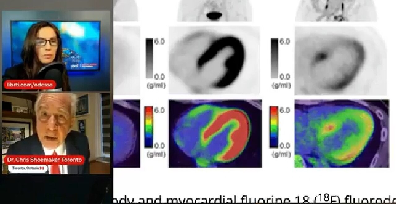 100% OF VAXXED HEARTS DAMAGED AS PER PET/CT SCANS. INTERVIEW WITH DR. SHOEMAKER 🔥