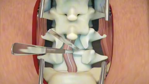 lumbar Discectomy Procedure Of Spine 3D Animation