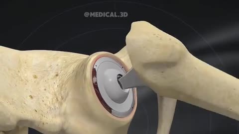 Hip Replacement Surgery (3D Animation)