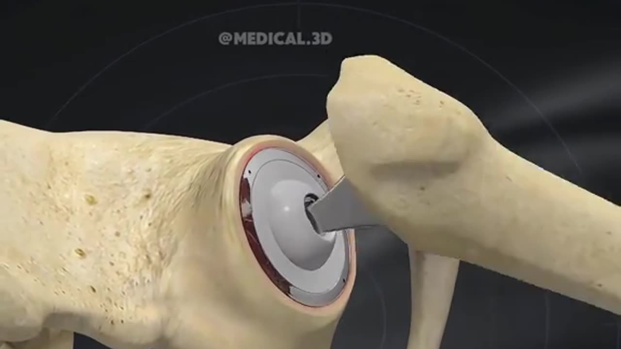 Hip Replacement Surgery (3D Animation)
