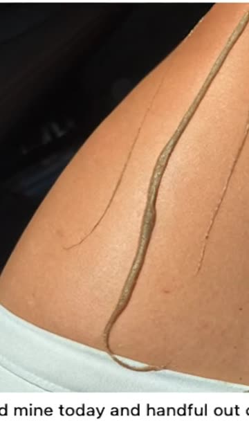 Parasites from a Woman's Lungs - Allergies gone!