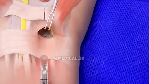 Carpal Tunnel Release Surgery (3D Animation)