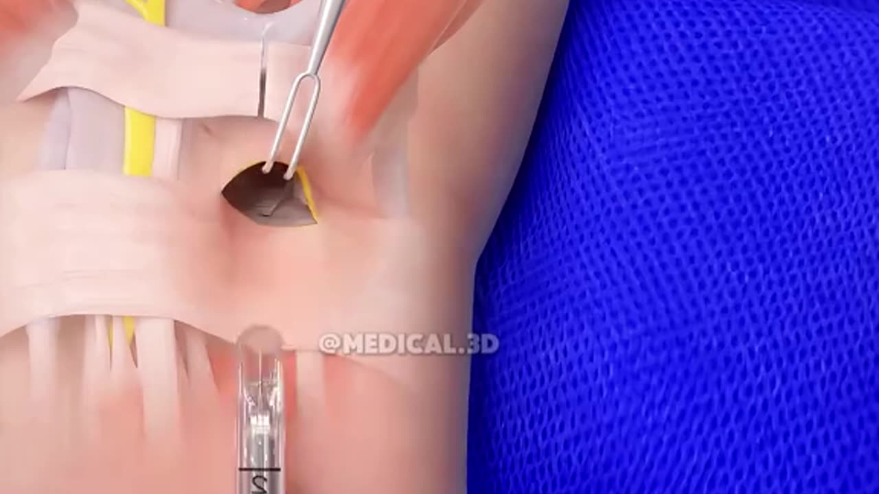 Carpal Tunnel Release Surgery (3D Animation)