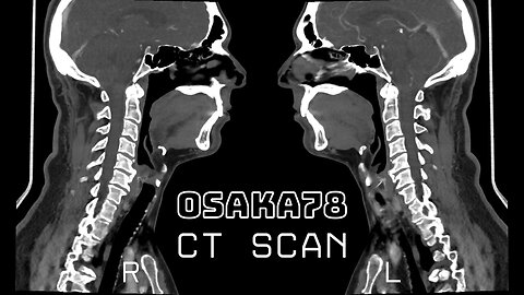 OSAKA78 CT SCAN