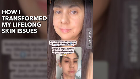 How I Transformed My Lifelong Skin Issues
