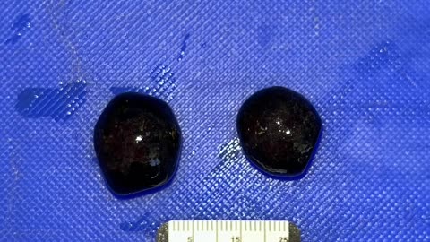 On Gallstones