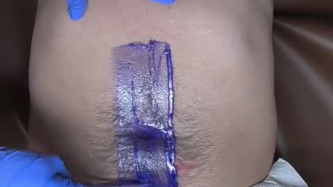 Full Stomach & Chest Waxing Transformation using Sexy Smooth Sexy Sapphire | @etherealskinllc.co