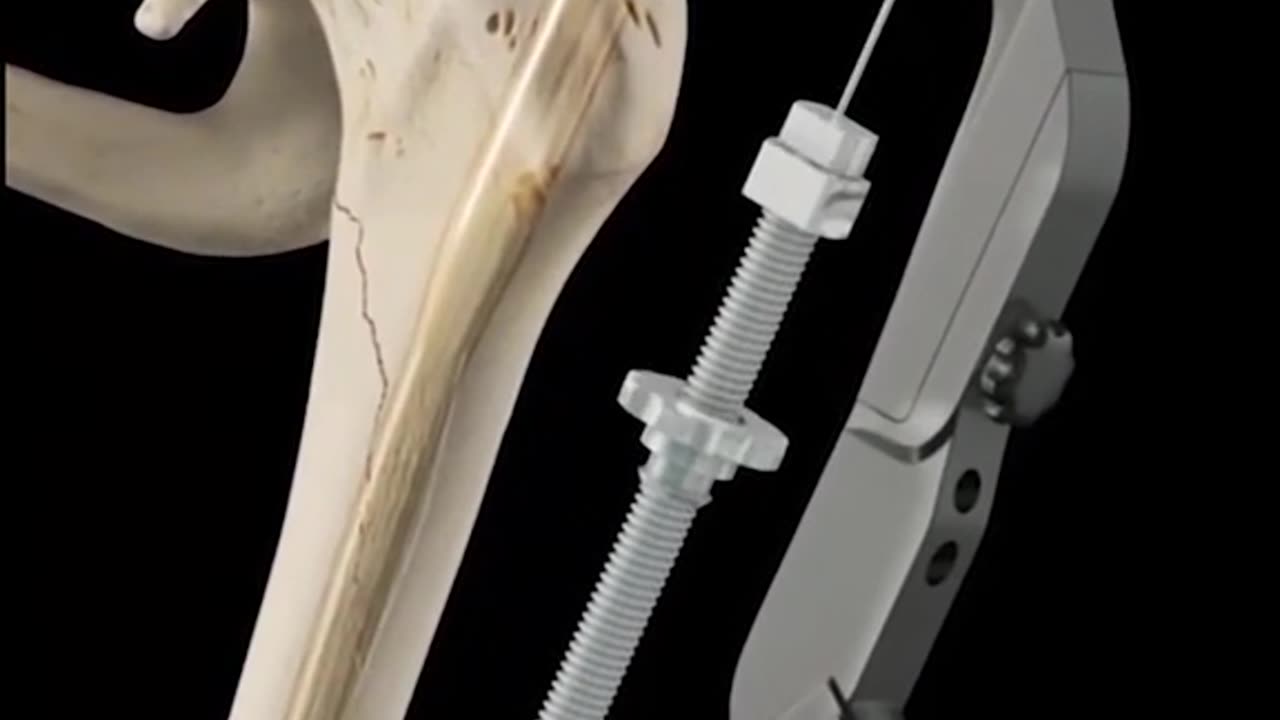 Intermedullary Nail Fixation 3D Animation