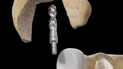 Elbow Arthroplasty With Cement 3D Animation
