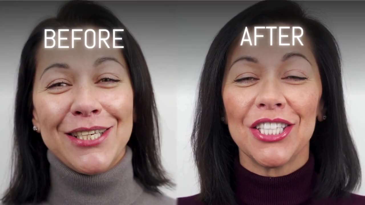 Dental Veneers Pasadena * Call (626) 577-7770 | Dr. Jennifer Cha