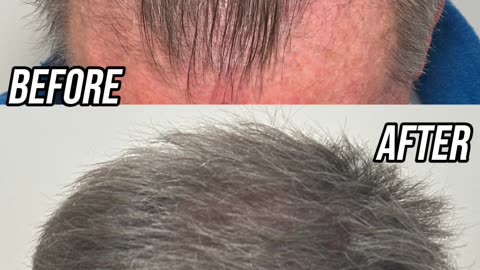 Incredible 6 Month Post Surgery Transformation!