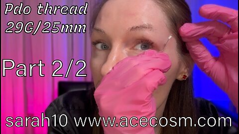 2/2 under eyes area and crow’s feet. Pdo thread 29/25