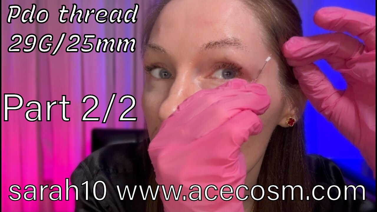 2/2 under eyes area and crow’s feet. Pdo thread 29/25