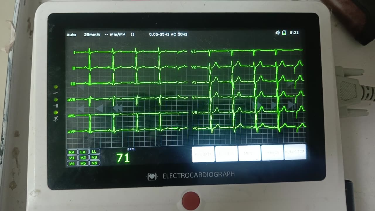 ECG report: what you think about it