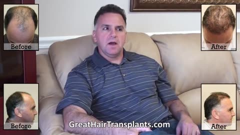 Dr. Brett Bolton Delivers Another Incredible Hair Transplant Result