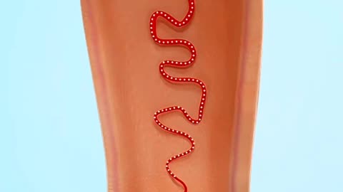 Hemorrhoids Artery Embolization Is Done