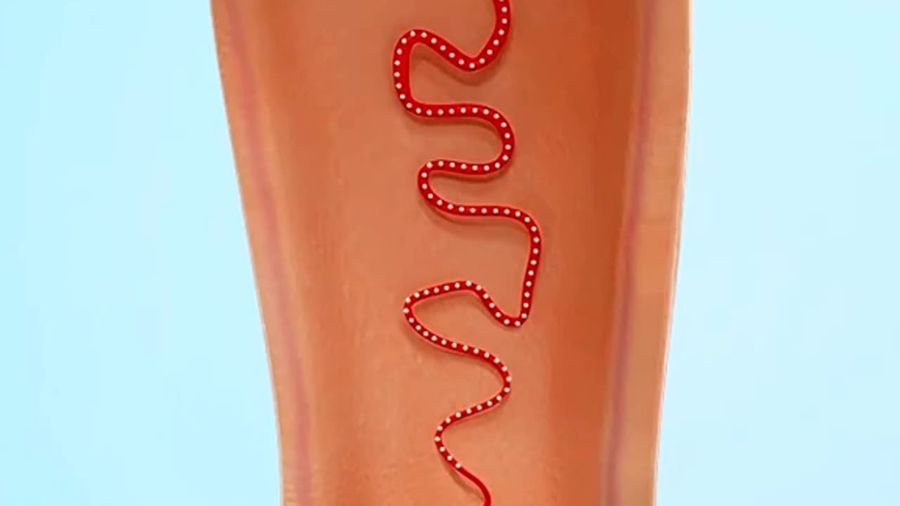 Hemorrhoids Artery Embolization Is Done