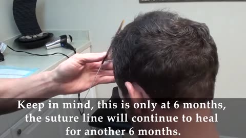 Dr. Brett Bolton Shows Undetectable Corrective Hair Transplant Scar