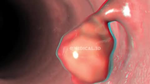 Colon Polypectomy Procedure (3D Animation)
