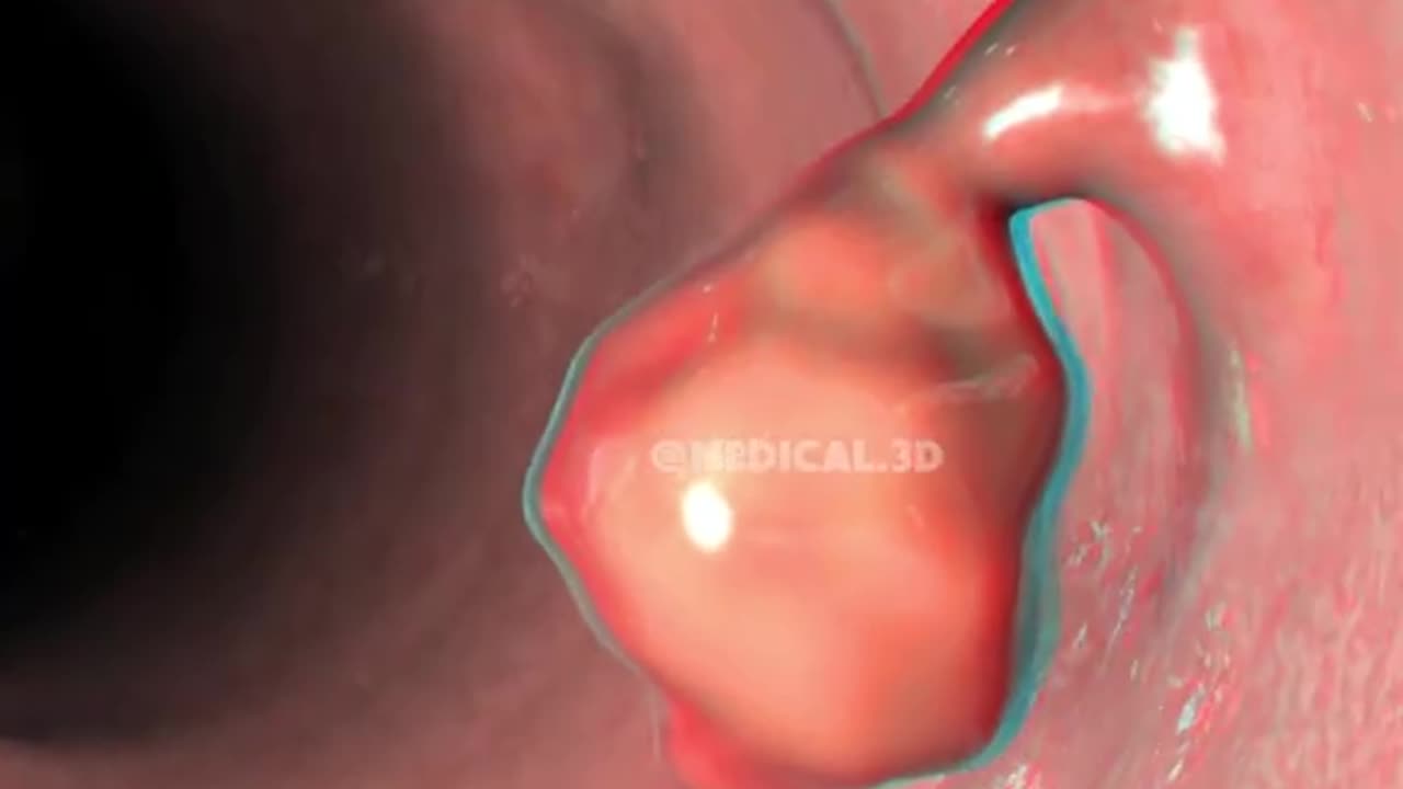 Colon Polypectomy Procedure (3D Animation)