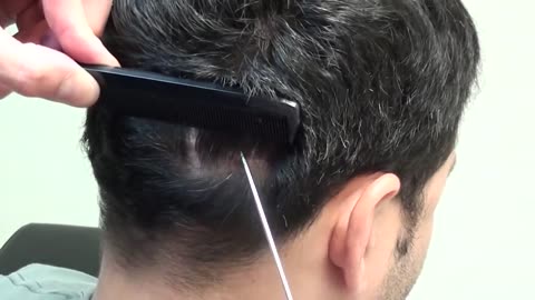 Corrective Hair Transplant Scar Repair – Dr. Brett Bolton