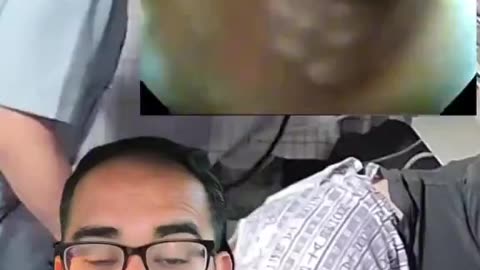 Colonoscopy removing a parasite. When last did you deworm?