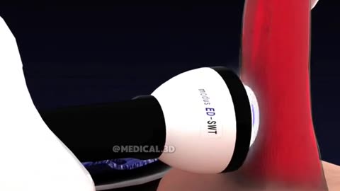 Shockwave Therapy Treatment (3D Animation)
