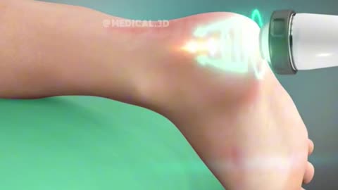Shockwave Therapy (3D Animation)