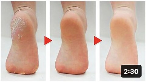 How to Get Rid of Calluses on Feet Naturally