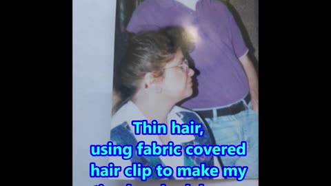 Photo Diary of my Hair Loss Journey